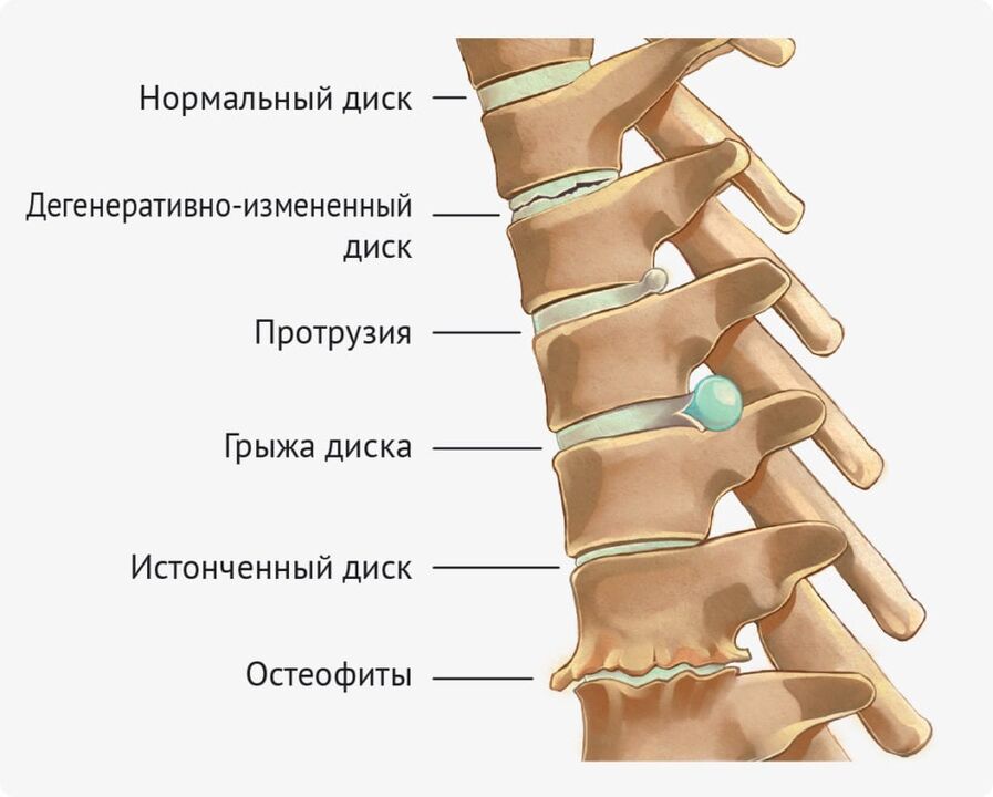 Deformidades de desconto para a osteocondrose lumbar