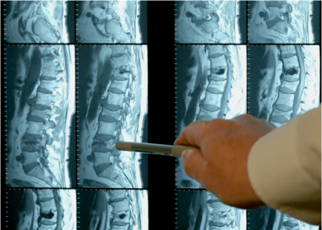 Variedades de osteocondrosis na columna vertebral