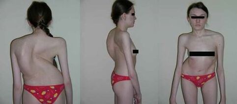 Craumático da columna vertebral como resultado da osteocondrose