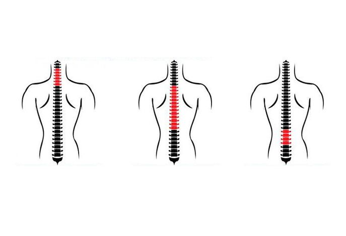 Como se manifesta a osteocondrose