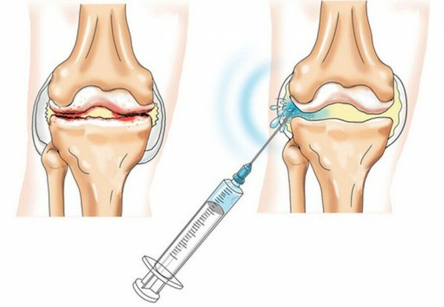 Inxección na articulación do xeonllo para a artrose