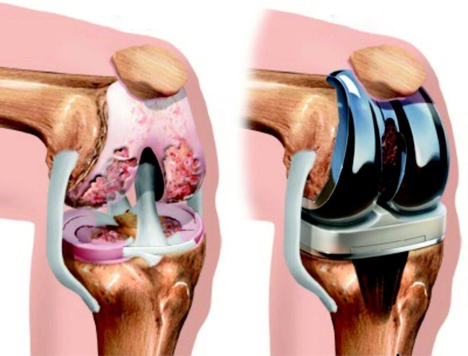 Se a articulación do xeonllo está completamente danada pola artrose, pódese restaurar mediante endoprótesis. 
