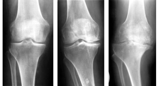 Unha medida de diagnóstico obrigatoria para determinar a artrose do xeonllo é unha radiografía